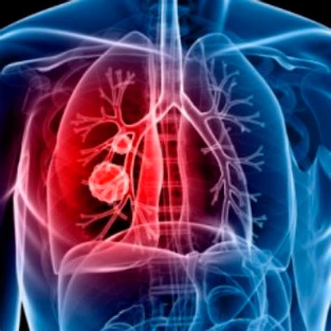 cancer no pulmão